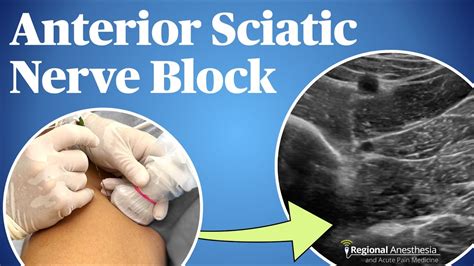 sciatic nerve block test